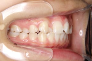 前歯の叢生がありますが口腔清掃状態はきれいです